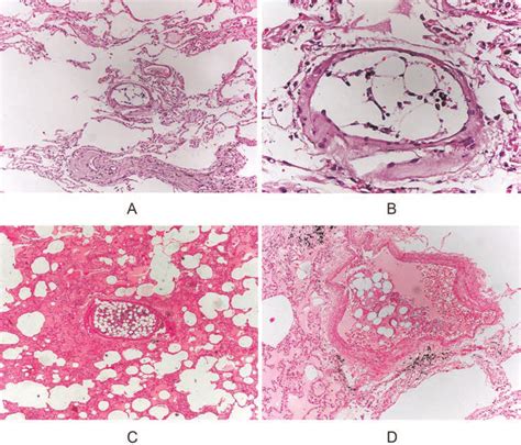 Fat Emboli The Round Holes In The Vascular Spaces Of The Lung Are Fat Download Scientific