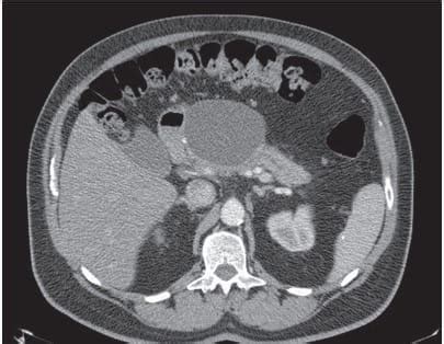 Endoscopic Ultrasound Guided Drainage Of Pancreatic Fluid Collections