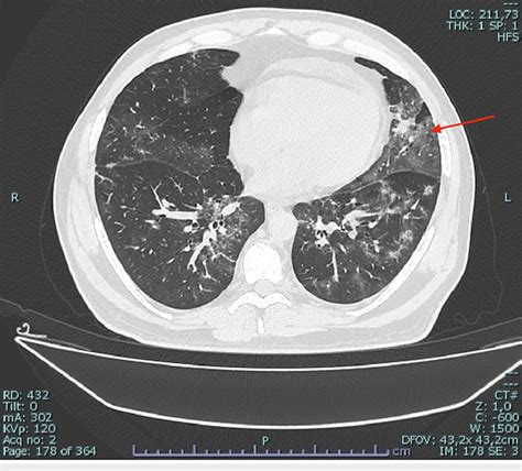 Chest CT Shows A Bilateral Patchy Distribution Of Groundglass Areas