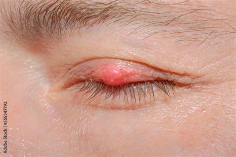 Foto De Eyelash Demodicosis Mite Diseas Demodex Chalazion On Eyelid