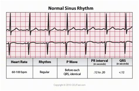 Ekg Strips Flashcards Quizlet