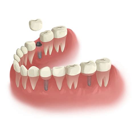 Everything You Need To Know About Wisdom Tooth Extractions - ST ...