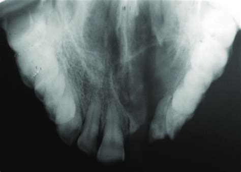 Maxillary Anterior Occlusal View Showing Lesion Download Scientific Diagram