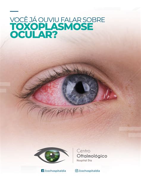 Você já ouviu falar sobre toxoplasmose ocular Centro Oftalmológico