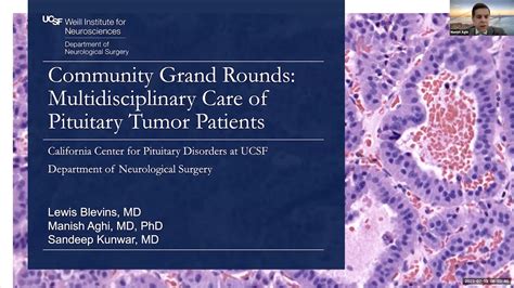 Multidisciplinary Care For Pituitary Tumor Patients Ucsf Community