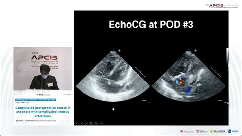 Complicated Postoperative Course After Repair Of Complicated Truncus