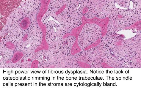 Pathology Outlines Fibrous Dysplasia