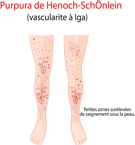 Purpura : causes, symptômes et traitements