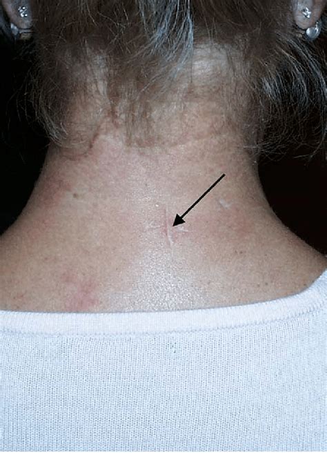 Discectomy Scar Neck