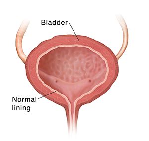 What Is Interstitial Cystitis Saint Luke S Health System