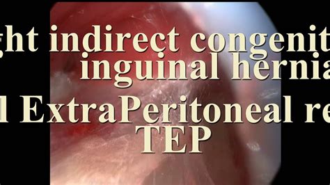 Laparoscopic Inguinal Hernia Repair Tep Youtube