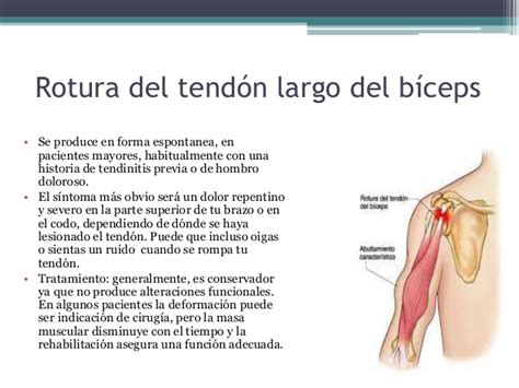 FMC BORMUJOS SIGNO DE POPEYE ROTURA TENDON LARGO BICEPS