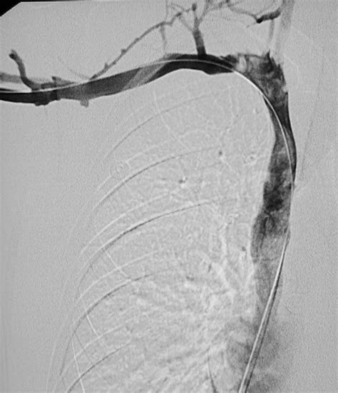 Venous Thromboembolic Disease Case Albany Ir