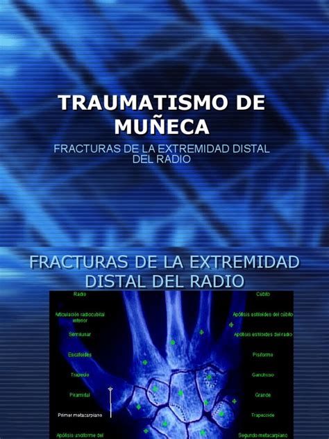 Pdf Fracturas De Mu Eca Pptshare Pdfslide Net