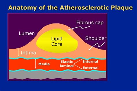 109 Anatomy Of The Atherosclerotic Plaque