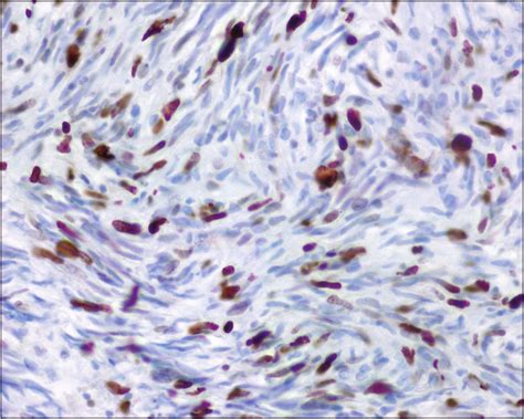 Microscopic section showing approximately 25% of tumor cells showing ...