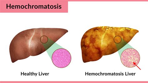 Hemochromatosis or Iron Overload: Causes, Symptoms, Treatment