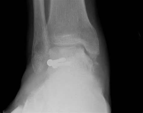 Talar Body Fracture The Bone School