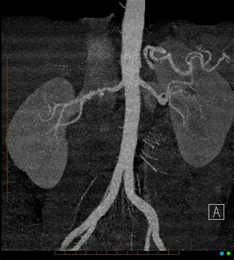 Fibromuscular Dysplasia Right Renal Artery Image