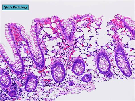 Qiaos Pathology Mucosal Pseudolipomatosis Of The Colon Flickr