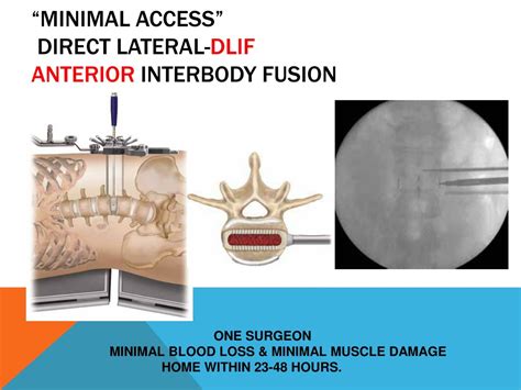 PPT - WHAT is a FUSION of the LUMBAR SPINE ? PowerPoint Presentation