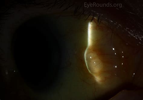 Conjunctival epithelial inclusion cyst