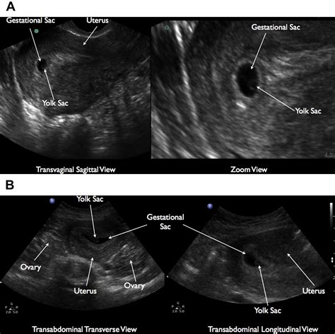 Bedside Ultrasonography For Obstetric And Gynecologic Emergencies Critical Care Clinics