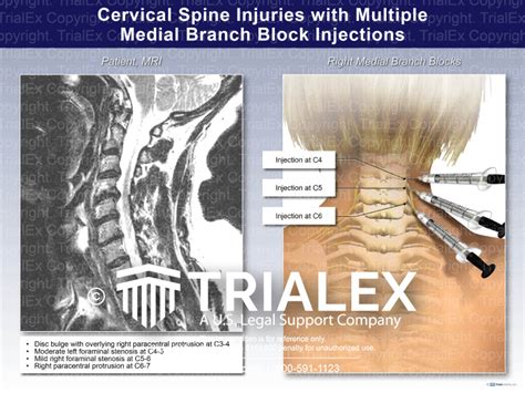 Cervical Spine Injuries With Multiple Medial Branch Block Injection