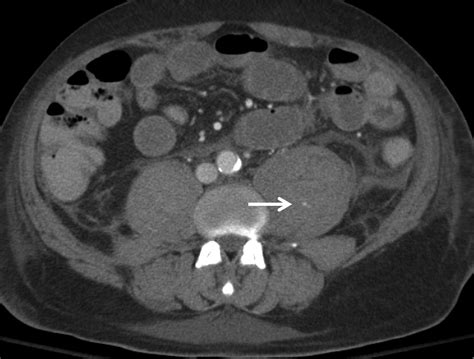 Computed Tomography An Optimal Modality For The Detection Of