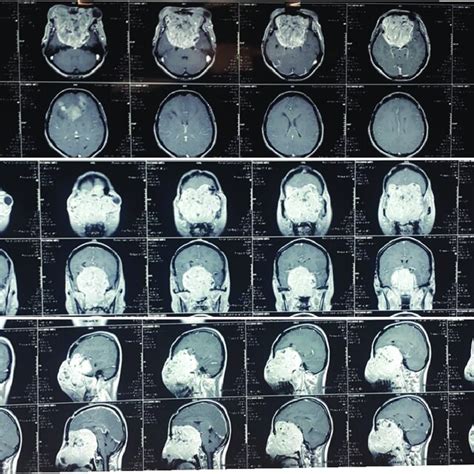 Magnetic Resonance Imaging Mri Scans Axial Sagittal And Coronal