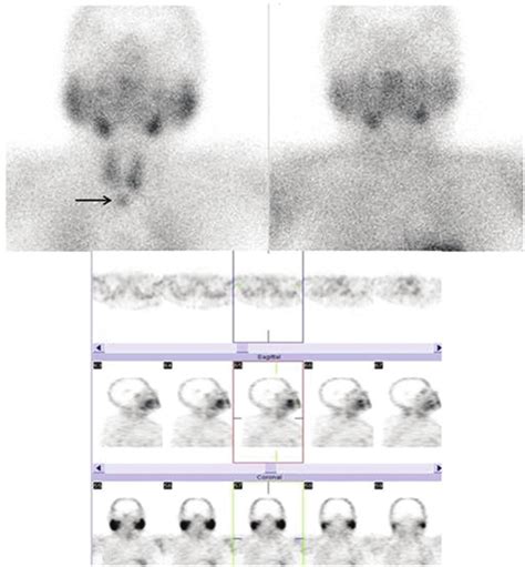 Early A And Late B Planar Views Of Dual Phase Technetium M