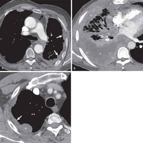 Pleural Neoplasms Radiology Key