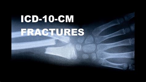 Icd 10 Cm Coding For Fractures Youtube