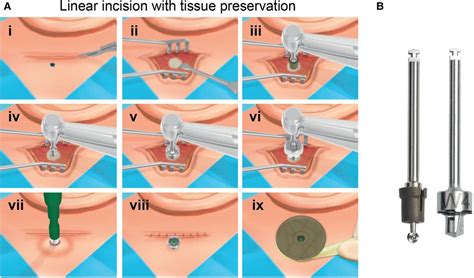 Minimally Invasive Surgery As A New Clinical Standard For Bone Anchored