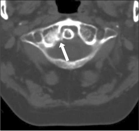 Axial View On Cervical Ct Scan Shows An Old Fracture Of The Lateral Download Scientific Diagram