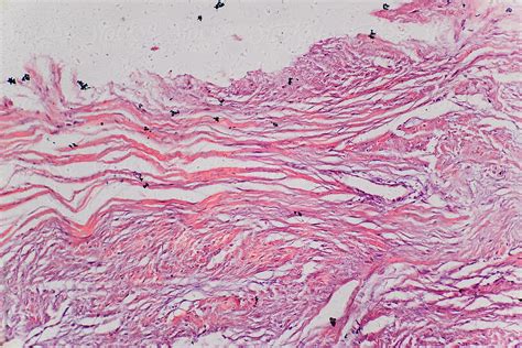 "Connective Tissue Hyaline Degeneration Of Human" by Stocksy ...