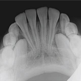 A Maxillary Occlusal Radiograph Showing Irregular Fracture Lines Of