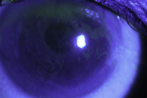 Cataract Surgery And Dry Eye