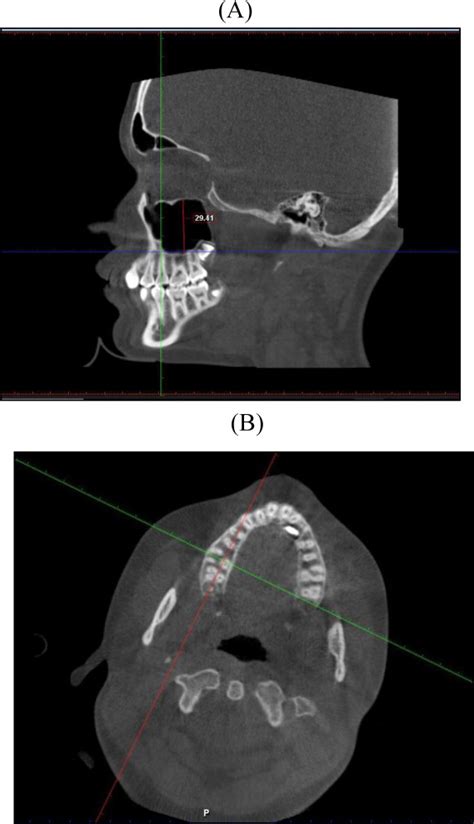 Fig A Adjustment Of Sagittal Section For Measuring The