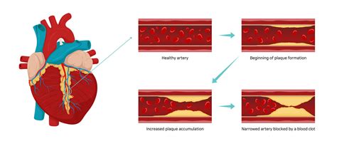 Atherosclerosis Causes And Risk Factors Hri