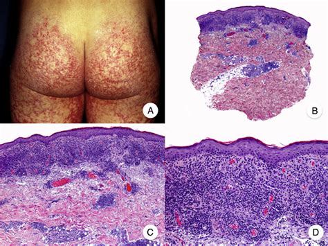 Poikilodermal Mycosis Fungoides A Photograph Showing Plaques With