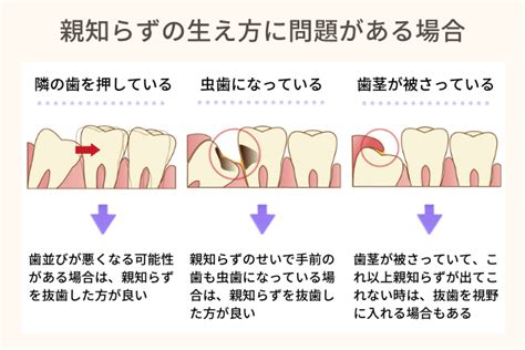 親知らずが生えてきたら抜いた方がいいの？｜よくあるご質問 クローバー歯科・矯正歯科あべの天王寺院