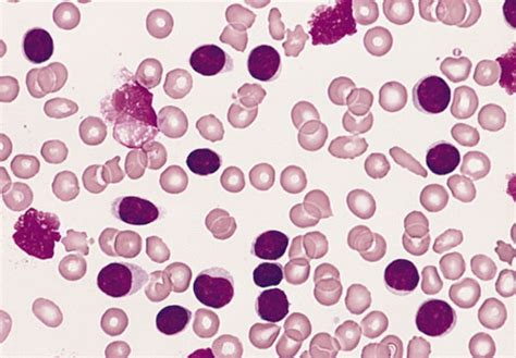 Chronic Lymphocytic Leukemia (CLL) - Oncology - Medbullets Step 1