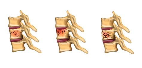 13 Vertebral Compression Fracture Symptoms To Watch For | Arizona Pain