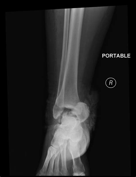 Talar Neck Fractures Trauma Orthobullets