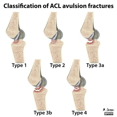 Diagram Classification Of Acl Avulsion Fractures Radiology Case