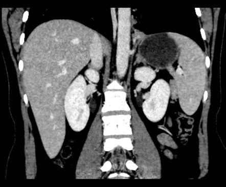 Pulmonary Sequestration Intralobar Radiology Case Radiopaedia Org