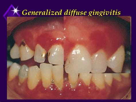 Chronic Gingivitis