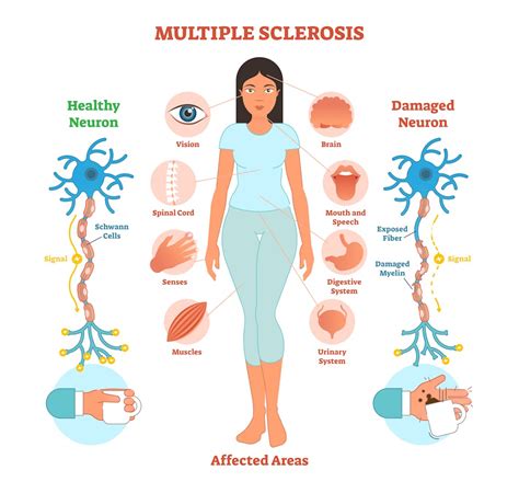 What Causes Multiple Sclerosis What We Know Dont Know And Suspect