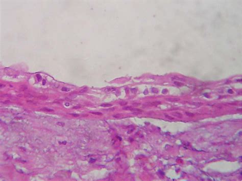 Figure 2 From Aggressive Growth And Neoplastic Potential Of Dentigerous Cysts With Particular